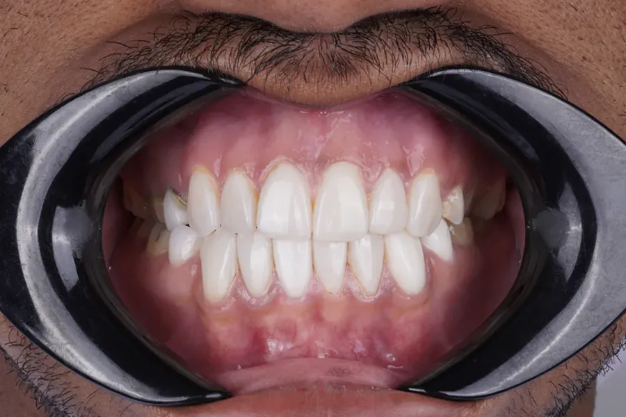 صورة توضح حالة الأسنان قبل بدء العلاج التجميلي، مع مشاكل لثة وتصميم عدسات غير مناسبة.