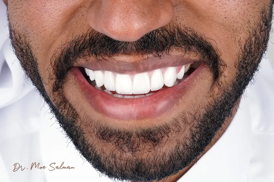 Cosmetic Dentistry in Qatar: A Successful Case That Restored Confidence and a Smile