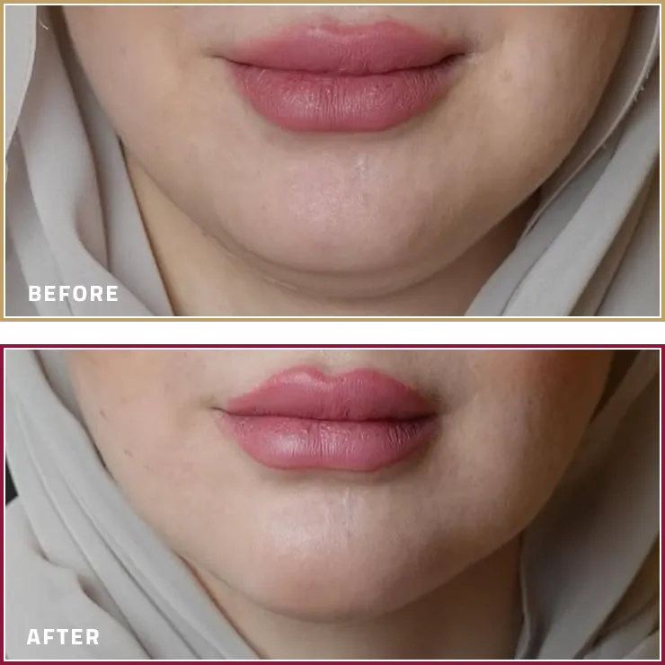 نتائج علاج اللغلوغ بجهاز المورفيوس أغنايت قبل وبعد مع الدكتورة أروى الماجدي في كارما كلينيك