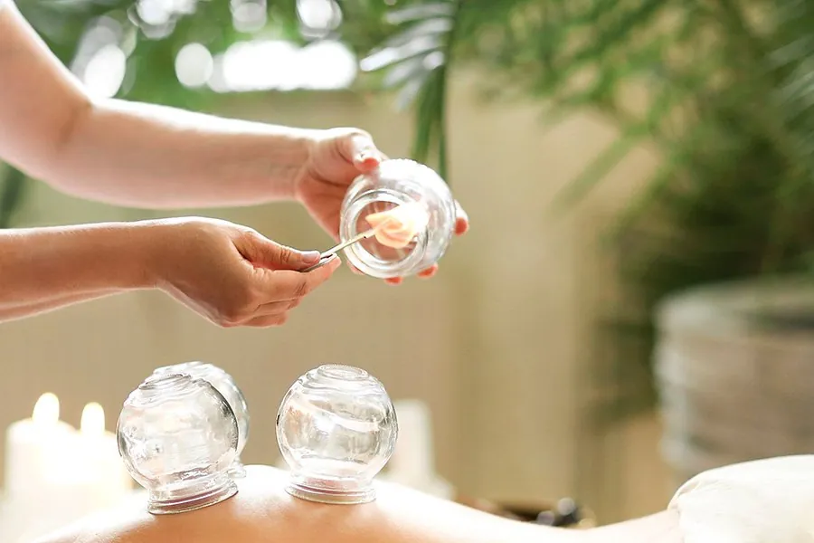 Cupping (Hijama) Between Arab and Chinese Traditions and Modern Medicine