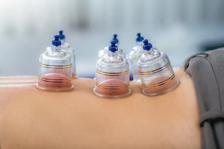 Cupping (Hijama) and Wrong Practices: Between Benefit and Complications