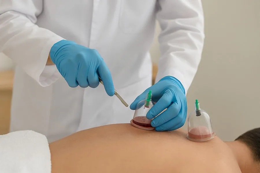 Cupping (Hijama) Between Science and Myth