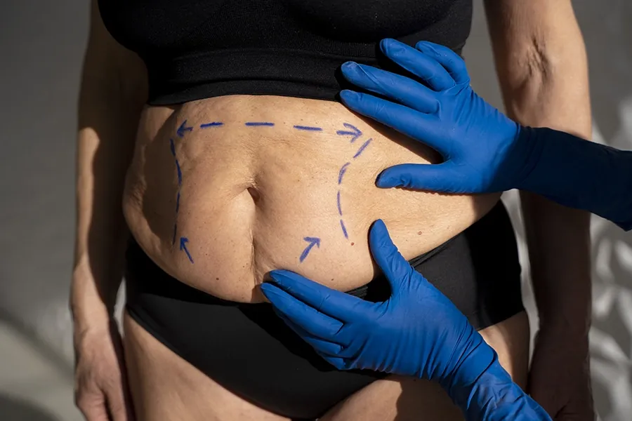 Is Liposuction Right for You? A Complete Guide Before You Decide