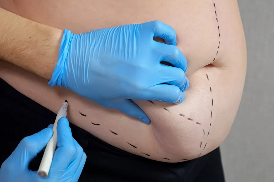 Liposuction Surgery in Qatar: Effective Solutions for Body Contouring