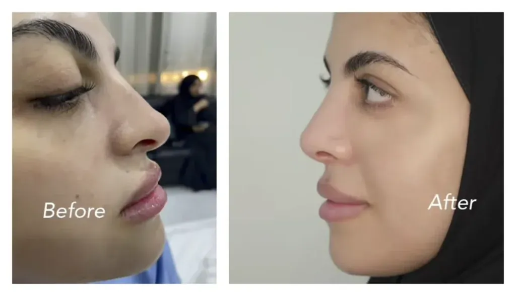 صورة مقارنة قبل وبعد عملية تجميل الأنف تظهر تحسن شكل الأنف وملامح الوجه في مجمع المحمود الطبي بقطر