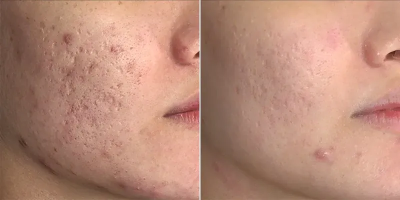 نتائج علاج ندبات حبّ الشباب بجهاز بيكوشور برو في مراكز المحمود الطبية قطر