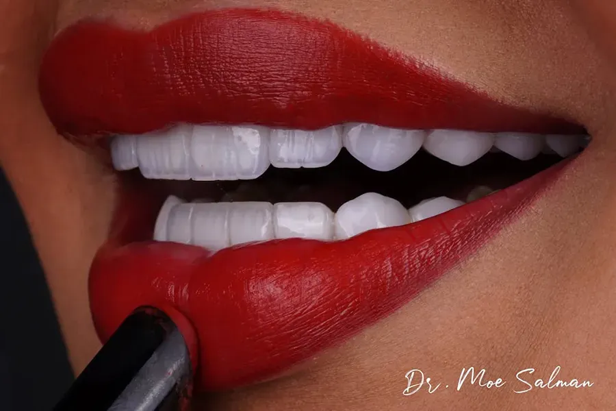 Teeth Cleaning in Qatar at Al Mahmoud Elite Medical Center