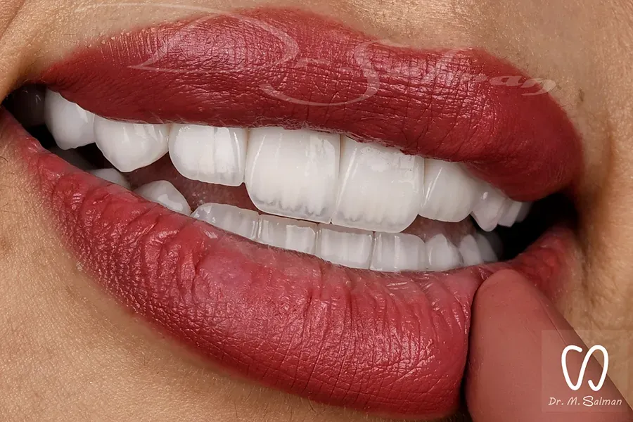 Dental Veneers in Qatar at Al Mahmoud Elite Medical Center