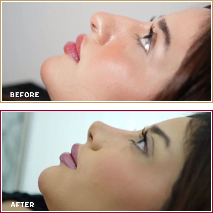 نتائج تجميل الأنف قبل وبعد للدكتور عجيل الجربا في مجمع المحمود الطبي