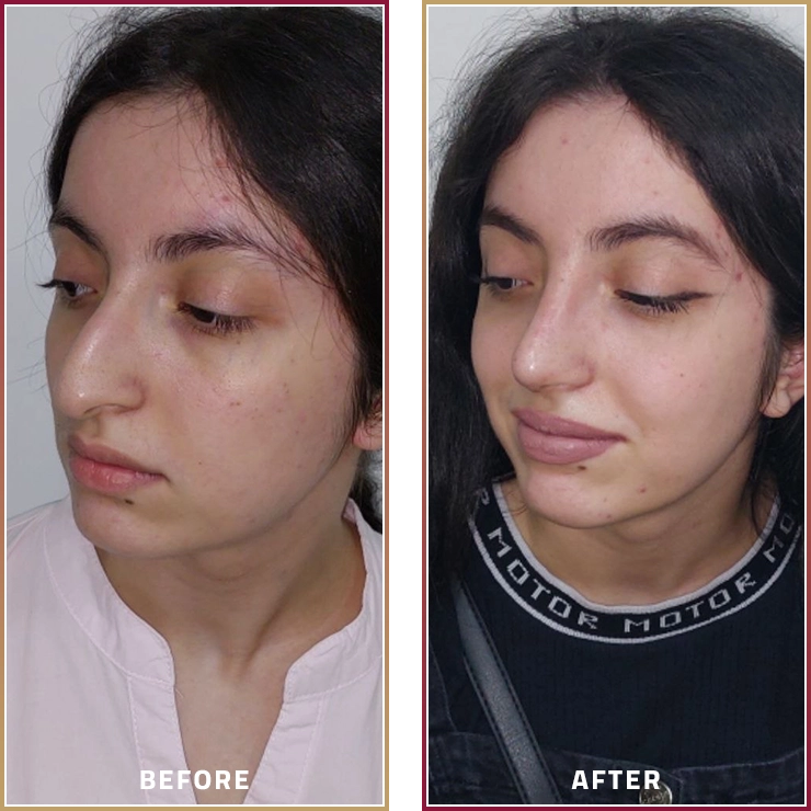 نتائج تجميل الأنف قبل وبعد مع الدكتور عجيل الجربا في مجموعة المحمود الطبية في قطر