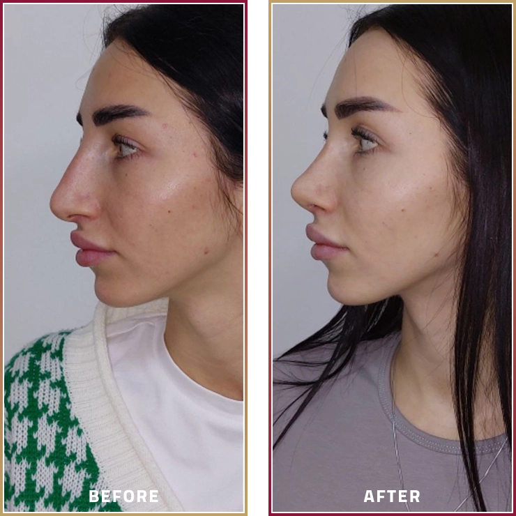عملية تجميل الأنف قبل وبعد مع الدكتور عجيل الجربا في مجموعة المحمود الطبية في قطر