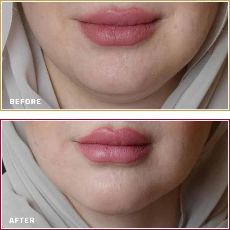 نتائج علاج اللغلوغ بجهاز المورفيوس أغنايت قبل وبعد مع الدكتورة أروى الماجدي في كارما كلينيك