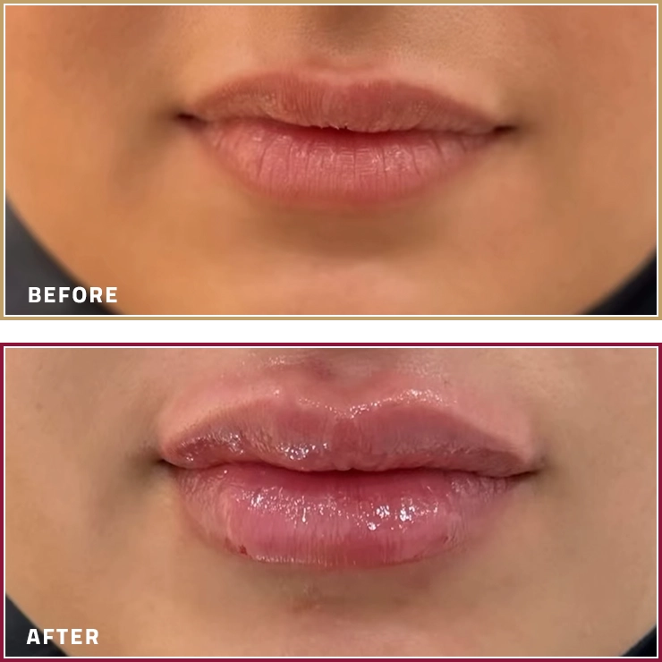 نتائج فيلر الشفايف مع د. بشار بشير أخصائي الجلدية والتجميل في مجمع النخبة الطبي.