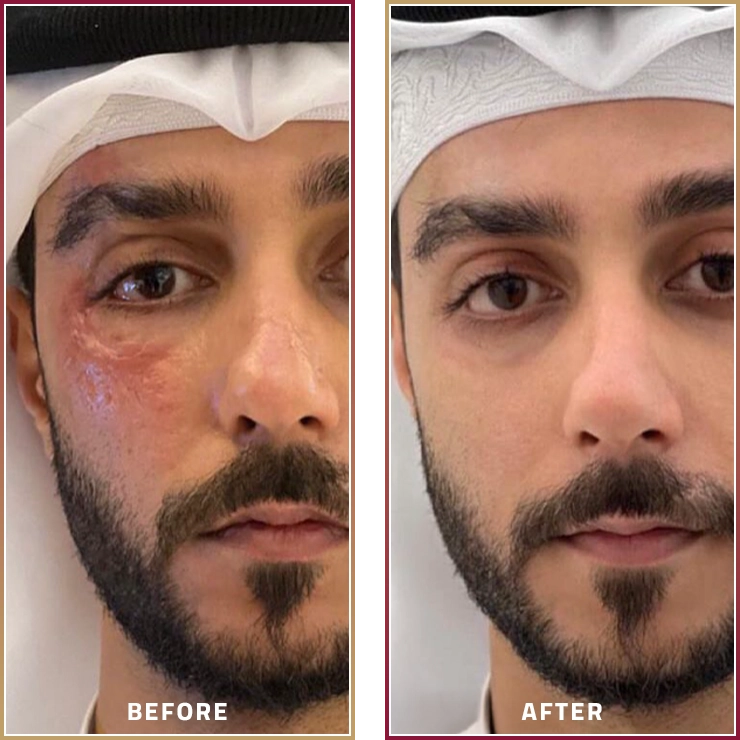 إزالة الندبات بالفراكشنال ليزر مع الدكتورة هاجر حسين في كارما كلينيك ضمن مجموعة المحمود الطبية في قطر
