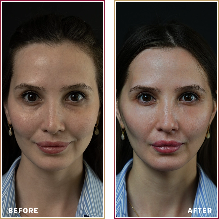 نتائج Baby Face Lifting مع د. هاجر حسين في مجموعة المحمود الطبية في قطر.