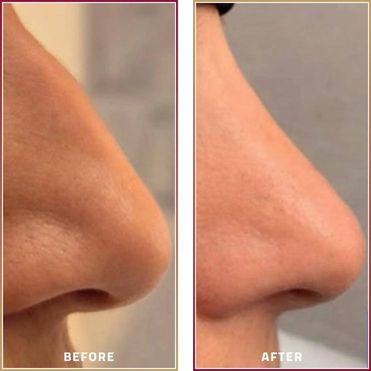 نتائج عملية تجميل الأنف قبل وبعد مع الدكتور كمال صالح في مجموعة المحمود الطبية في قطر