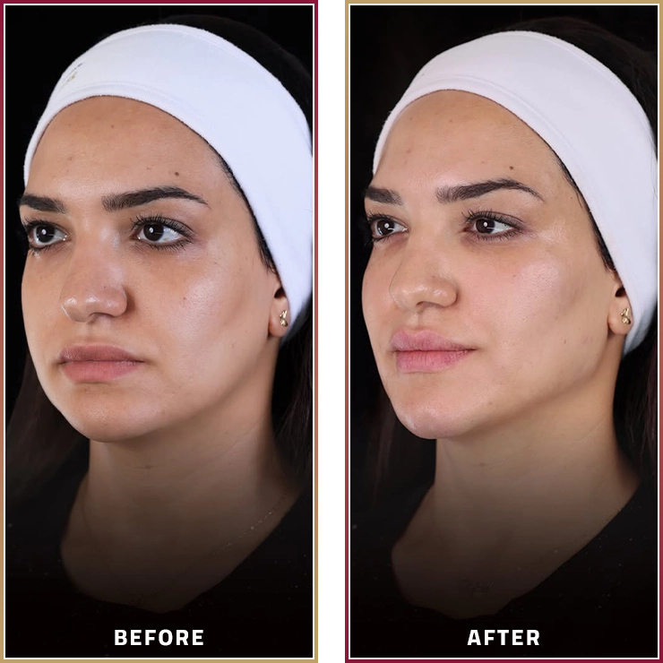 نتائج Face Lifting مع د. ليلى سعود في مجموعة المحمود الطبية في قطر.