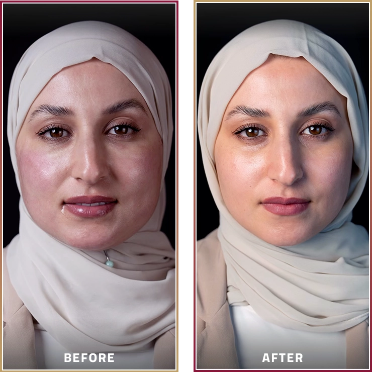 نتائج إبرة النضارة تحت العين وإبرة السيستيما للوجه قبل وبعد مع الدكتورة رباب دوه جي في كارما كلينيك.