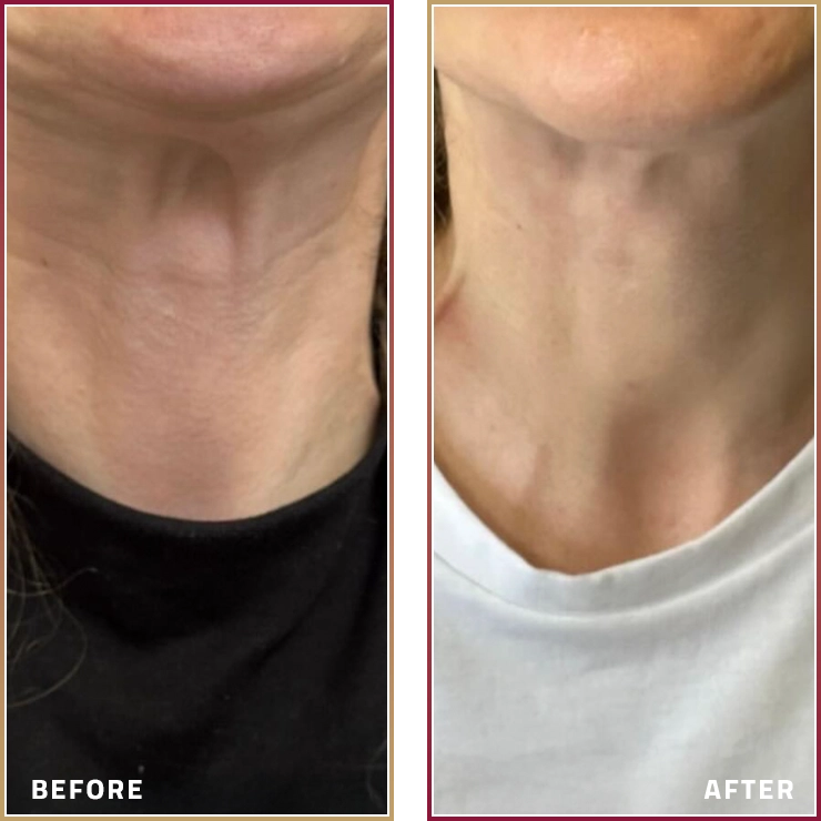 شد الرقبة بالبوتوكس مع د. رشا نبهان في مجموعة المحمود الطبية في قطر.