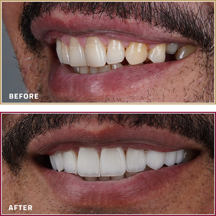 تجميل الابتسامة قبل وبعد مع الدكتور عماد خير الله في مجموعة المحمود الطبية في قطر