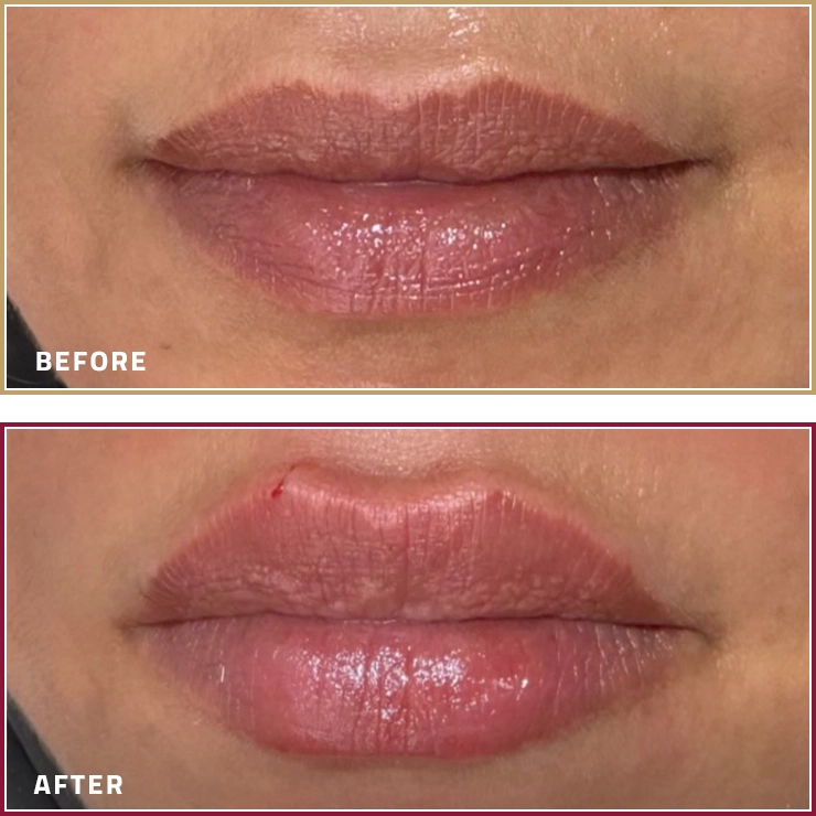نتائج فيلر الشفايف VIP Lips مع د. حازم العفير في مجموعة المحمود الطبية في قطر.