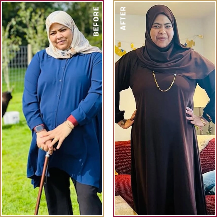 قبل وبعد جراحة السمنة مع د. علي الحمداني في مجمع المحمود بريميوم الطبي