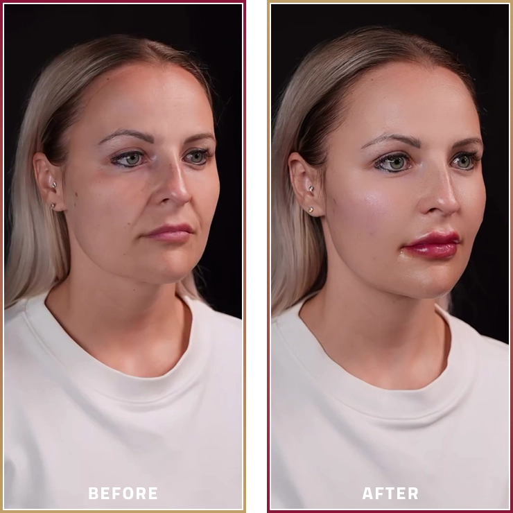 قبل وبعد إبرة الكاريزما مع Eye Booster وLip Booster مع د. زينب محمد